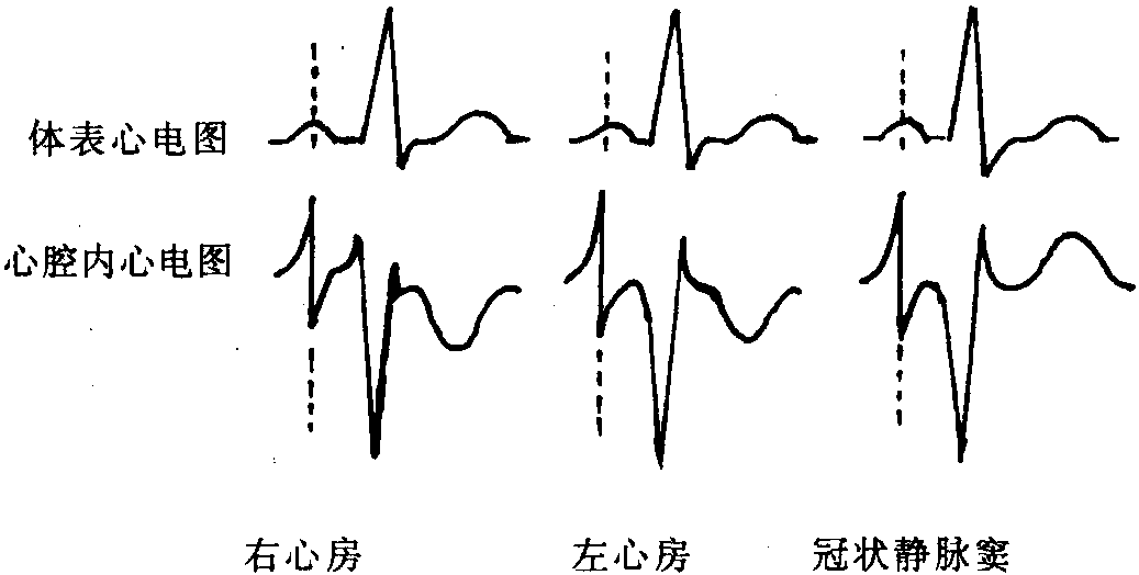 二 心腔內(nèi)心電圖